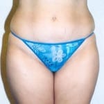 Liposuction 04 Before Thumbnail Photo