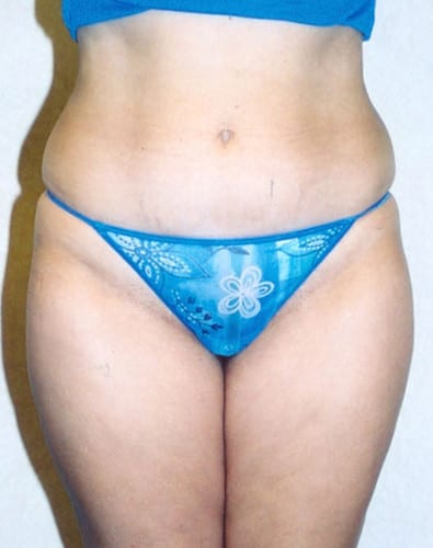 Liposuction 04 Before Photo