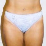 Liposuction 04 After Thumbnail Photo