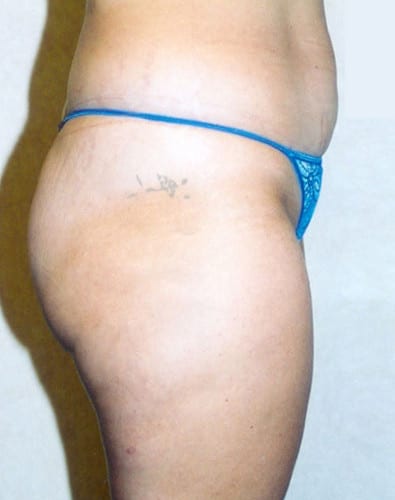 Liposuction 04 Before Photo