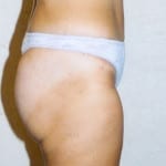 Liposuction 04 After Thumbnail Photo