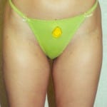 Liposuction 05 After Thumbnail Photo