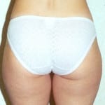 Liposuction 05 Before Thumbnail Photo