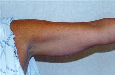 Liposuction 06 Before Photo