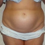 Liposuction 07 Before Thumbnail Photo