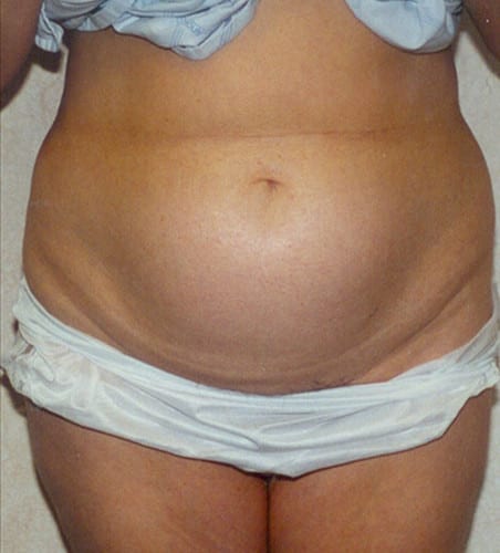 Liposuction 07 Before Photo