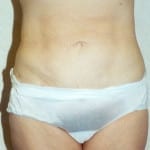 Liposuction 07 After Thumbnail Photo