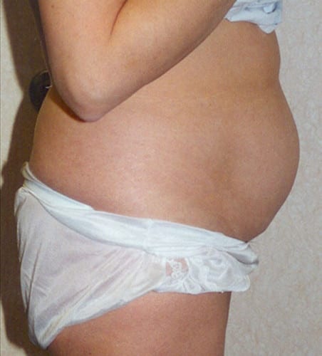 Liposuction 07 Before Photo
