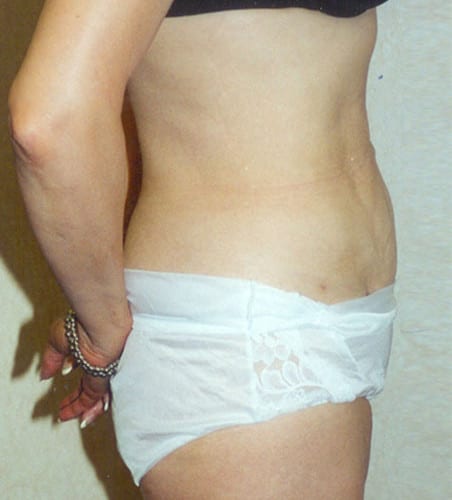 Liposuction 07 After Photo