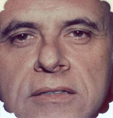 Rhinoplasty 01 Before Photo