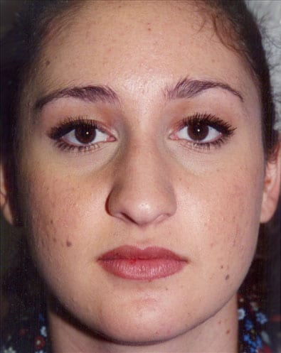 Rhinoplasty 02 Before Photo
