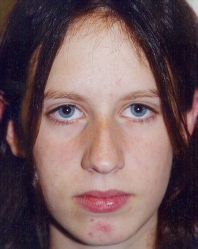 Rhinoplasty 03 Before Photo