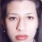 Rhinoplasty 04 Before Thumbnail Photo