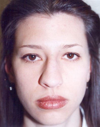 Rhinoplasty 04 Before Photo