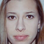 Rhinoplasty 04 After Thumbnail Photo