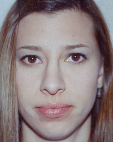 Rhinoplasty 04 After Photo