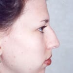 Rhinoplasty 04 Before Thumbnail Photo