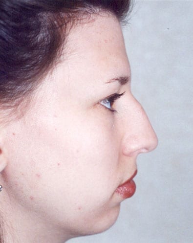 Rhinoplasty 04 Before Photo