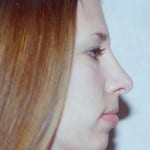 Rhinoplasty 04 After Thumbnail Photo