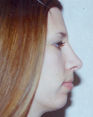 Rhinoplasty 04 After Photo