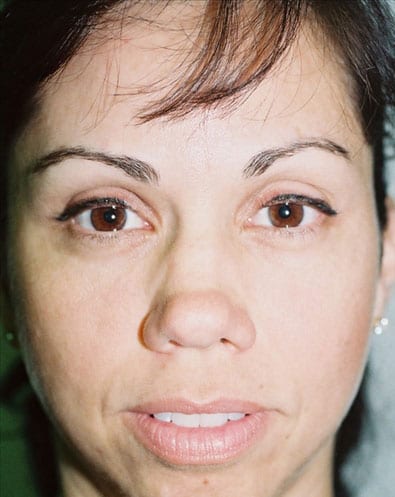 Rhinoplasty 05 Before Photo