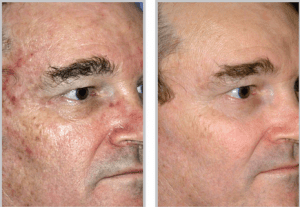 Sciton® Laser Skin Resurfacing