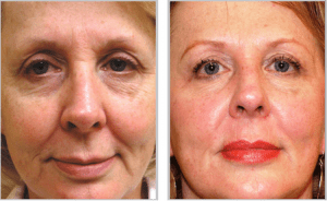 Sciton® Laser Skin Resurfacing