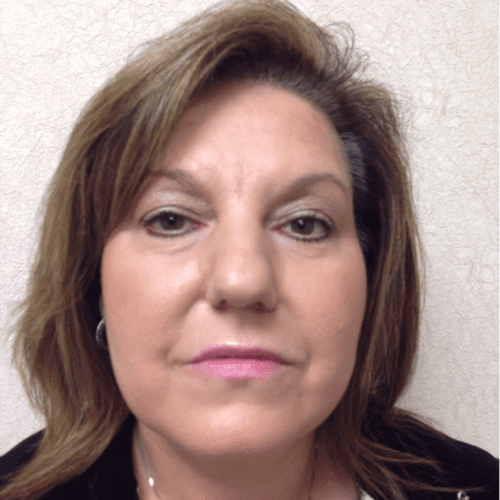 Rhinoplasty 06 Before Photo