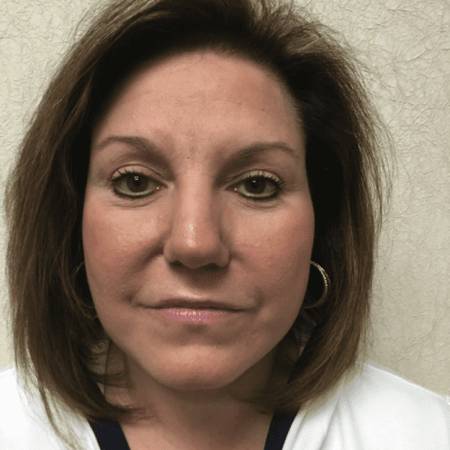 Rhinoplasty 06 After Photo