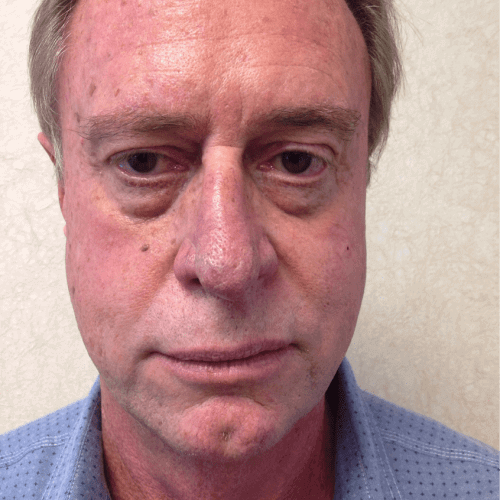 Male Cosmetic Surgery 09 Before Photo