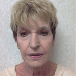 Blepharoplasty 06 After Thumbnail Photo