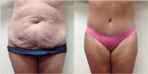Tummy Tuck Surgery Before and After