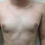 Gynecomastia 03 Before Thumbnail Photo