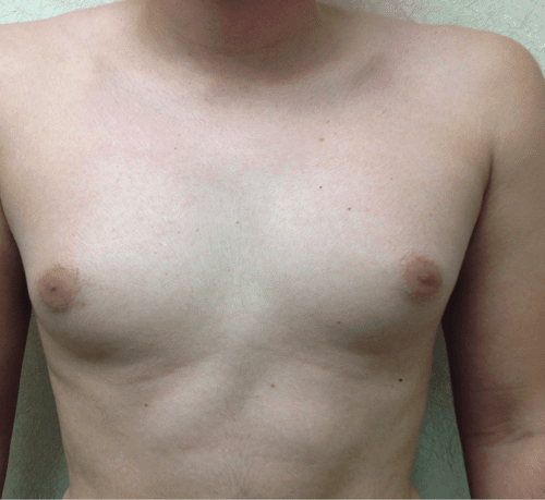 Gynecomastia 03 Before Photo