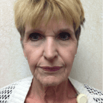 Blepharoplasty 06 Before Thumbnail Photo