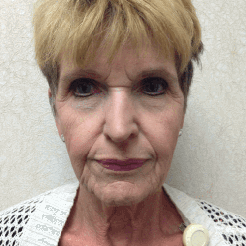 Blepharoplasty 06 Before Photo