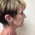 Blepharoplasty 06 After Thumbnail Photo