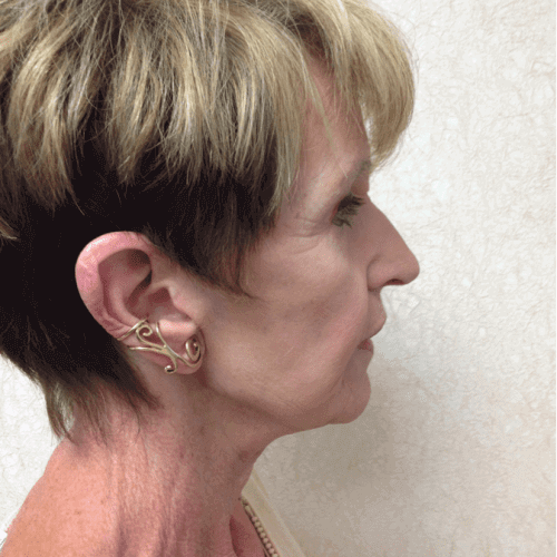 Blepharoplasty 06 After Photo