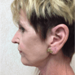 Blepharoplasty 06 After Thumbnail Photo