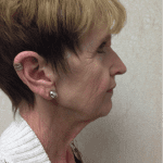 Blepharoplasty 06 Before Thumbnail Photo