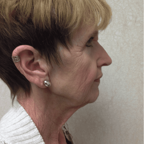 Blepharoplasty 06 Before Photo