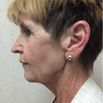 Blepharoplasty 06 Before Thumbnail Photo