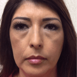 Liposuction 08 Before Thumbnail Photo