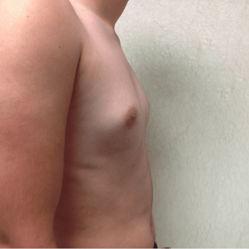 Gynecomastia 03 Before Photo