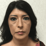 Liposuction 08 After Thumbnail Photo