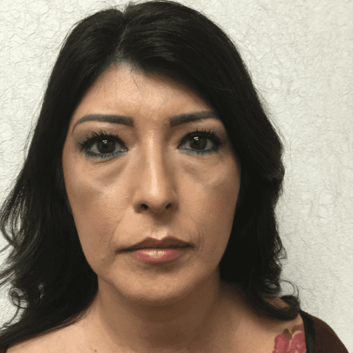 Liposuction 08 After Photo