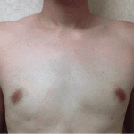 Gynecomastia 03 After Thumbnail Photo