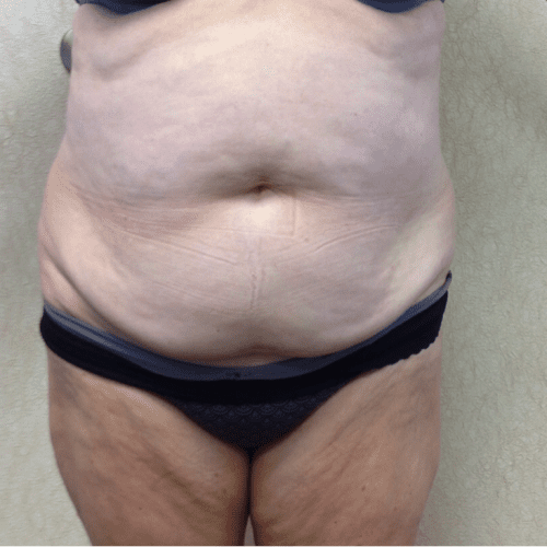 Abdominoplasty 07 Before Photo