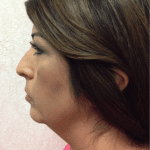 Liposuction 08 Before Thumbnail Photo