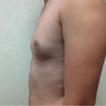 Gynecomastia 03 Before Thumbnail Photo